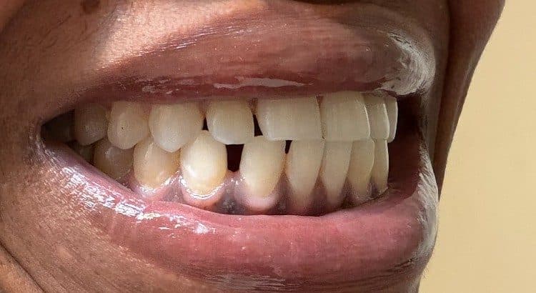 Smile showing crowded front teeth