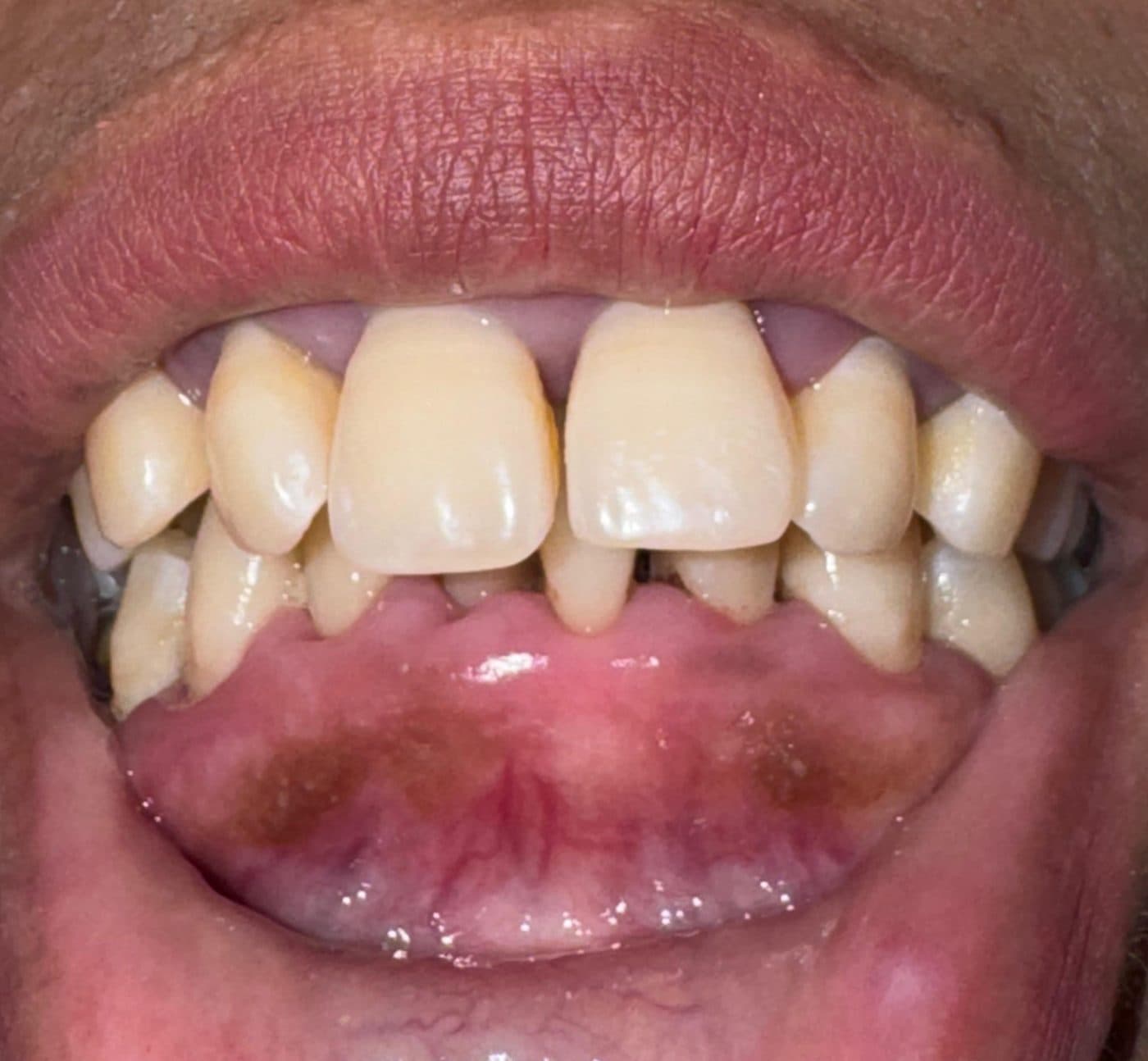 Front view of the teeth